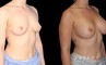 Smoother recovery for patient who chose silicone implants for breast augmentation. Breast position was maintained to keep a natural look that enhances her body type’s contours.