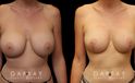 Procedures Depicted:  Breast Augmentation – Silicone & Lift