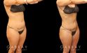 Before and after of 360 liposuction and BBL combination, focusing on removal of fat on the waist and back with abdominal contouring. Transferred fat to butt resulted in a rounder position with a natural feel and shape ideal for the patient's body type. The patient's Brazilian butt lift recovery went smoothly and results settled well following the recovery period.