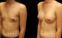 Patient results from breast augmentation, showing the increase from minimal breast size to a round, fuller appearance that suits her body shape.