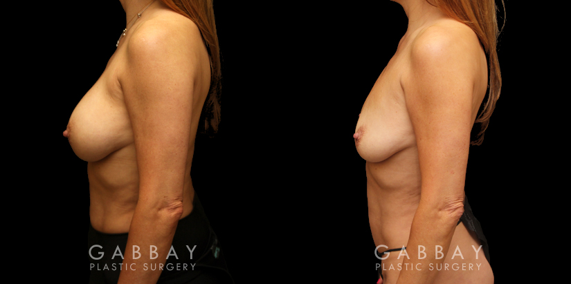 Procedures Depicted:  Mini tummy tuck and lipo to waist