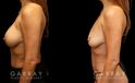 Procedures Depicted:  Mini tummy tuck and lipo to waist