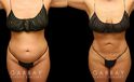 Female abdominal fat removal results showcasing a patient’s flatter tummy area, with no side effects from the liposuction procedure. The fat removed is permanently gone, with straightforward maintenance of results.