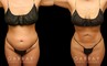 Female abdominal fat removal results showcasing a patient’s flatter tummy area, with no side effects from the liposuction procedure. The fat removed is permanently gone, with straightforward maintenance of results.