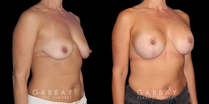Procedures Depicted:  Wise Mastopexy with Silicone Breast Implants