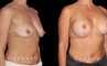 Procedures Depicted:  Wise Mastopexy with Silicone Breast Implants