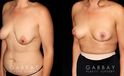 Procedures Depicted:  Mastopexy and Liposuction