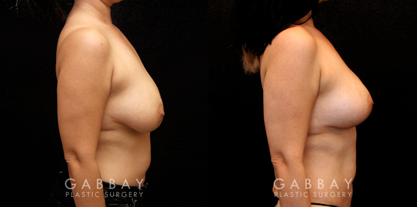 Procedures Depicted:  Breast lift and auto aug