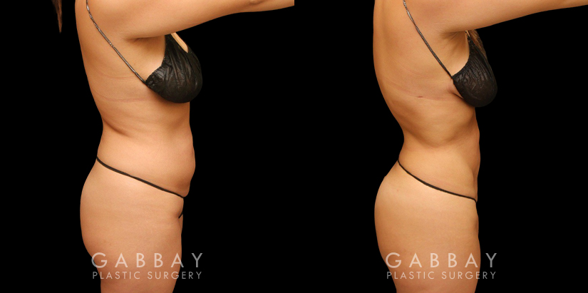 Female abdominal fat removal results showcasing a patient’s flatter tummy area, with no side effects from the liposuction procedure. The fat removed is permanently gone, with straightforward maintenance of results.
