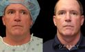 Male neck liposuction results for mid 50s man. Photos demonstrate the contour around the jawline for an overall enhanced masculine jawline contour. Though subtle and refined, the results are noticeable from multiple angles.