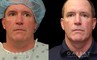 Male neck liposuction results for mid 50s man. Photos demonstrate the contour around the jawline for an overall enhanced masculine jawline contour. Though subtle and refined, the results are noticeable from multiple angles.