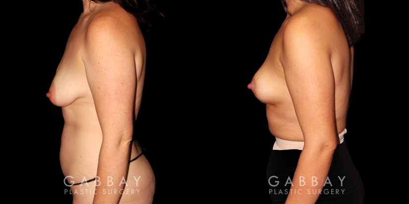 Procedures Depicted:  Mastopexy and Liposuction