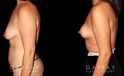Procedures Depicted:  Mastopexy and Liposuction