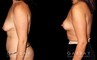 Procedures Depicted:  Mastopexy and Liposuction
