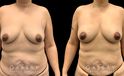 Patient 17 Front View Breast Fat Grafting Gabbay Plastic Surgery