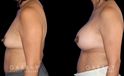 Patient before and after silicone implants with complete, uncomplicated recovery. Volume increase is notable while also improving the balance between breasts without resorting to unnatural perfect symmetry.