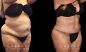 Tummy tuck patient results after abdominal tightening and liposuction to remove loose skin and stubborn pockets of fat. Note the complete tightening of back rolls, resulting in a smoother profile.