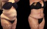 Tummy tuck patient results after abdominal tightening and liposuction to remove loose skin and stubborn pockets of fat. Note the complete tightening of back rolls, resulting in a smoother profile.