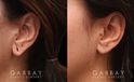 Patient 06 Left Side View Earlobe Repair Gabbay Plastic Surgery