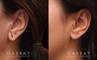 Patient 06 Left Side View Earlobe Repair Gabbay Plastic Surgery