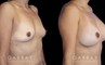 Breast augmentation results including silicone implant augmentation combined with tummy tuck and flank liposuction. The final result is a tightened body contour with enhanced breast size.