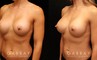 Patient 01 3/4th Left Side View Breast Revision Gabbay Plastic Surgery