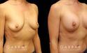 Patient with combined areola lift and breast augmentation, photos showing her before and after the procedure. Not the improved breast position and increased volume.