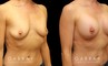 Patient with combined areola lift and breast augmentation, photos showing her before and after the procedure. Not the improved breast position and increased volume.