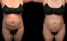 Abdominal liposuction results for female patient who wanted to address stubborn belly fat that did not respond to diet and exercise. Results show reduced overall profile that also lends itself to her natural body shape and features.