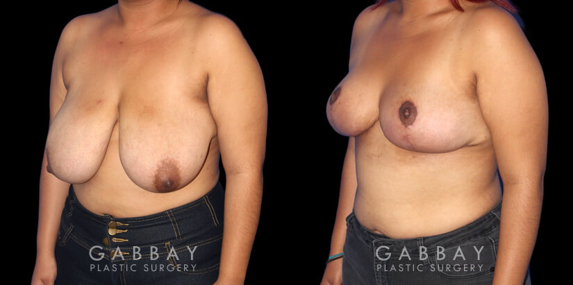 Procedures Depicted:  Implant removal with aug/pexy