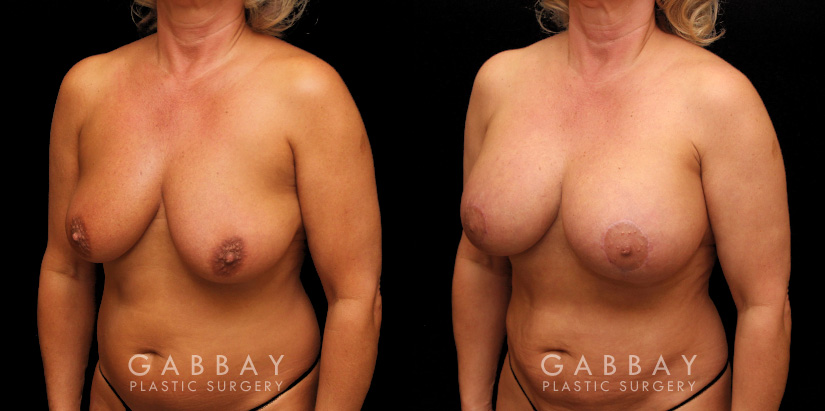 Procedures Depicted:  Breast Aug/Pexy with Liposcution and J-plasma to the Full Abdomen and Upper Back Bra Roll