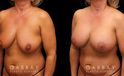 Procedures Depicted:  Breast Aug/Pexy with Liposcution and J-plasma to the Full Abdomen and Upper Back Bra Roll