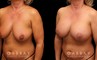 Procedures Depicted:  Breast Aug/Pexy with Liposcution and J-plasma to the Full Abdomen and Upper Back Bra Roll