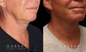 Patient 01 3/4th Right Side View facelift, full neck lift, upper blepharoplasty Gabbay Plastic Surgery
