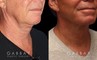 Patient 01 3/4th Right Side View facelift, full neck lift, upper blepharoplasty Gabbay Plastic Surgery