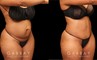 Tummy tuck patient before and after her procedure. Photos demonstrate the lack of visible scarring, a flattened abdomen, and removal of stretch marks through precise tightening techniques.