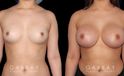 Silicone breast implants after full recovery. Patient increased breasts by several cup sizes without stretching out the skin, maintaining a round alluring shape with boosted volume.