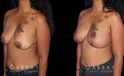Procedures Depicted:  Wise Mastopexy with Silicone Breast Implants