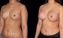Silicone breast implants after full recovery. Patient increased breasts by several cup sizes without stretching out the skin, maintaining a round alluring shape with boosted volume.
