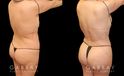 Female patient after liposuction that was combined with fat transfer to the buttocks. This lipo and BBL combination produced a slimmer figure while enhancing the roundness of the butt.