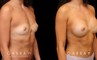 Patient after breast augmentation with silicone implants. Not the round and perky position of the breasts following recovery and dissipation of swelling.