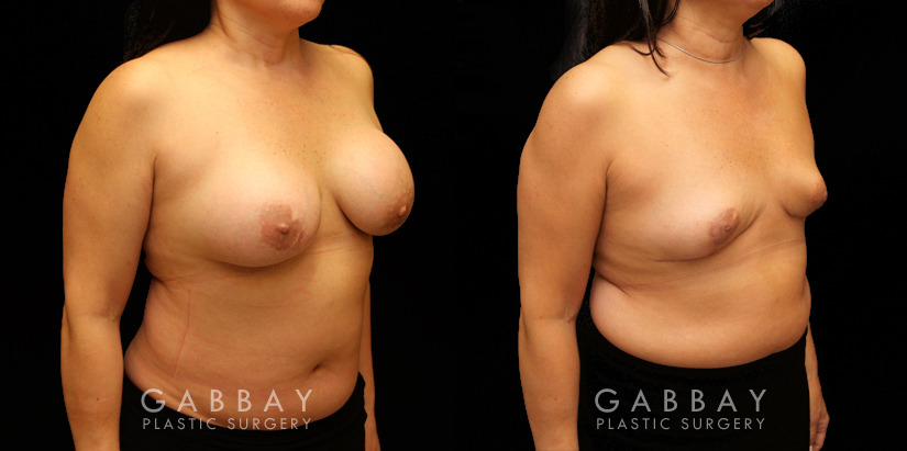 Procedures Depicted:  Auto Augmentation with lift