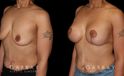 Procedures Depicted:  Breast Augmentation – Silicone & Lift