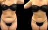 Before and after liposuction surgery for reducing mild bulging pockets of fat on the upper and lower abdomen, restoring a tighter stomach appearance without and bulging fat.