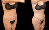 Female patient after liposuction that was combined with fat transfer to the buttocks. This lipo and BBL combination produced a slimmer figure while enhancing the roundness of the butt.