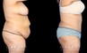 Patient results after liposuction to the back bra roll with significant abdominal tightening. Note the decrease in volume of abdominal fat and excess skin, with no visible scarring from any angle. Patient achieved a flat profile silhouette absent of any folds.