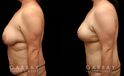 Procedures Depicted:  Tummy Tuck and Breast lift