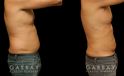 Male liposuction results after reducing stubborn belly fat that would not respond to diet or exercise. The belly area went from significant overhang above the beltline to a flatter contour.