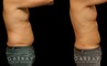 Male liposuction results after reducing stubborn belly fat that would not respond to diet or exercise. The belly area went from significant overhang above the beltline to a flatter contour.