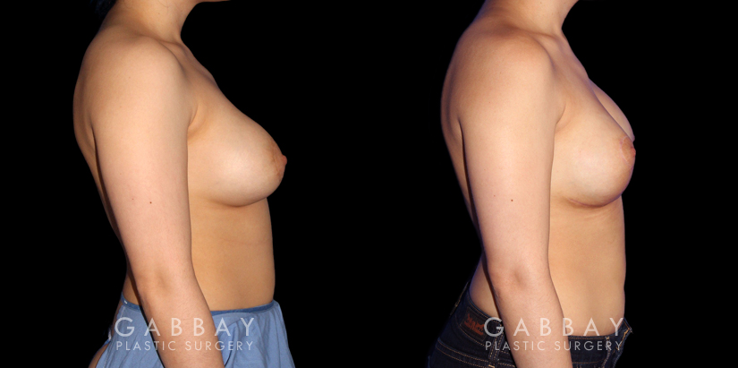 Procedures Depicted:  Breast Augmentation-Remove and Replace Saline & Full Lift